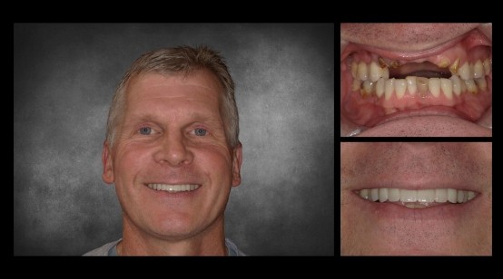 Smile before and after treating gapped teeth