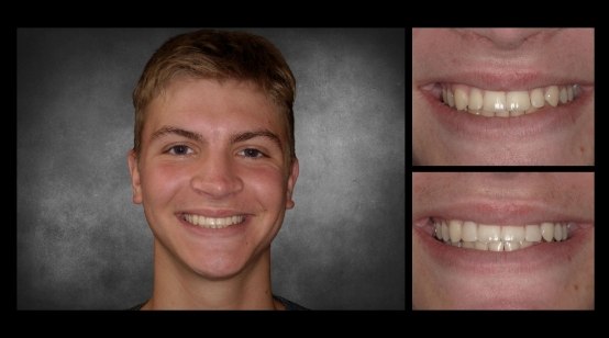 Close up of teeth before and after white stain treatment