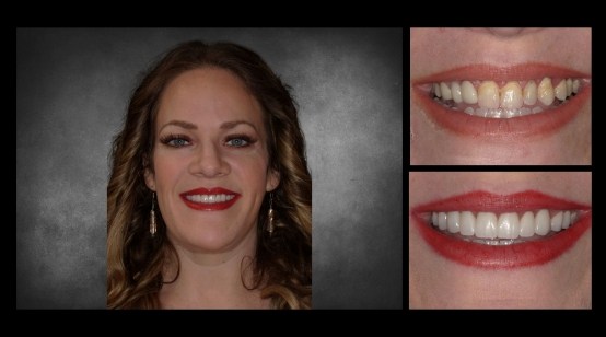 Close up of mouth before and after correcting chipped teeth