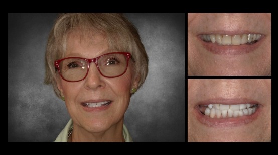 Smile before and after treating discolored and chipped teeth