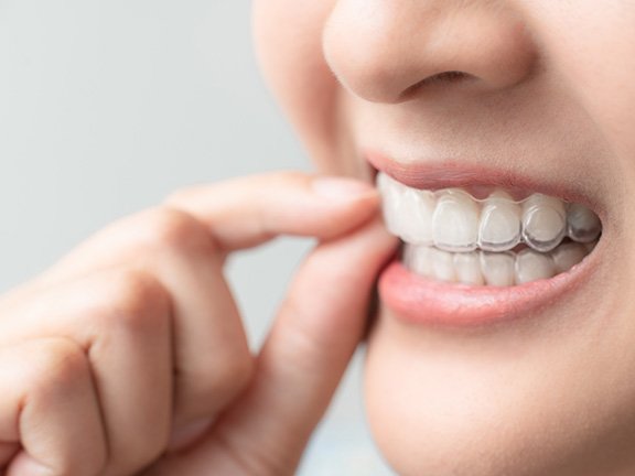 Closeup of patient putting on clear aligner