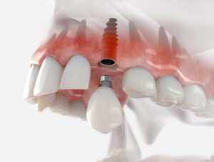 digital image of dental implant toward the front of the mouth