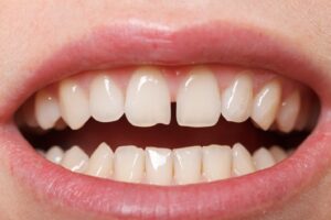 Close-up of smile showing small gap between two front teeth.